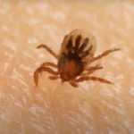 Ezt tegyük, ha beszakad a kullancs feje, így kell helyesen eltávolítani