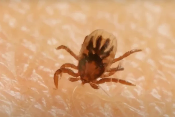 Ezt tegyük, ha beszakad a kullancs feje, így kell helyesen eltávolítani